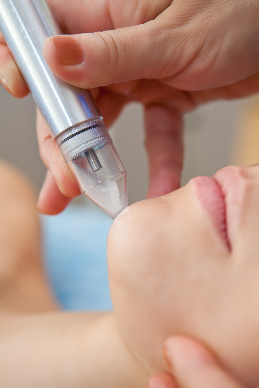 Microdermabrasion